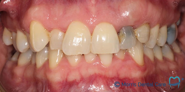 Image of a very dark and small tooth next to her upper front tooth, which stood out when the patient smiled.